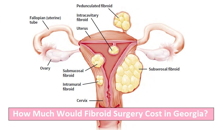 fibroid surgery cost in Georgia 2020