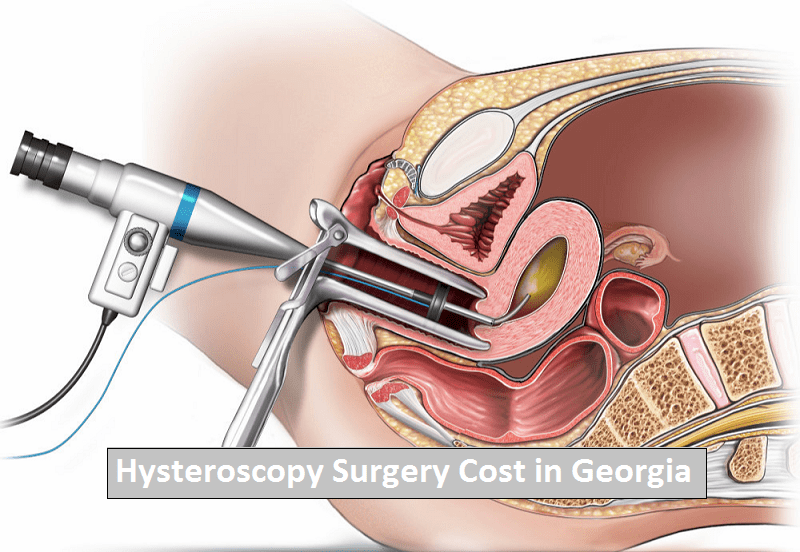 Hysteroscopy Surgery Cost in Georgia 2020